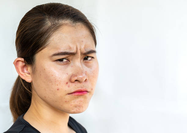 Cara Menghilangkan Bekas Jerawat Merah Pada Kulit Sensitif. Sumber: Pixabay