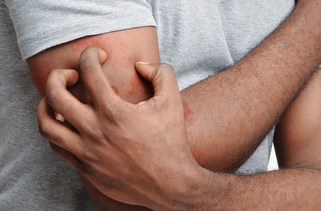 Penyakit kudis adalah penyakit kulit yang membuat kulit menjadi iritasi dan gatal-gatal. Foto: Cleveland Clinic Health