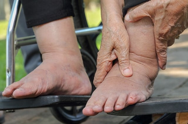 Penyakit filariasis merupakan penyakit yang diakibatkan oleh cacing. Foto: kumparan