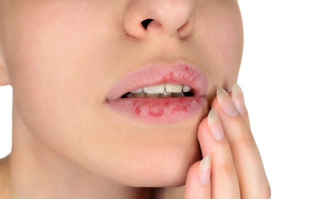 Ilustrasi bibir kering dan pecah-pecah yang meresahkan sebagian perempuan. Foto: Pixabay
