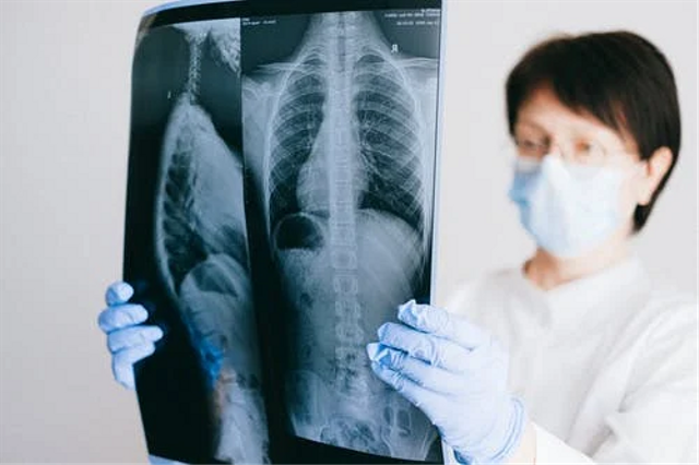 Penyakit paru-paru yang disebabkan oleh bakteri adalah tuberkulosis atau TBC. Foto: Pexels.com