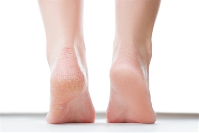 Ilustrasi Cara Mengatasi Kulit Kaki Kering. Sumber: Unsplash.
