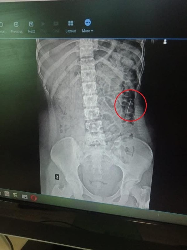 Hasil rontgent jarum pentul yang tertelan oleh seorang gadis asal Moro, Kabupaten Karimun. (Foto: ist/Batamnews)