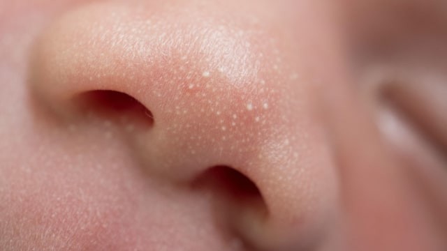 Cara menghilangkan bintik di wajah secara alami. Foto: Shutterstock