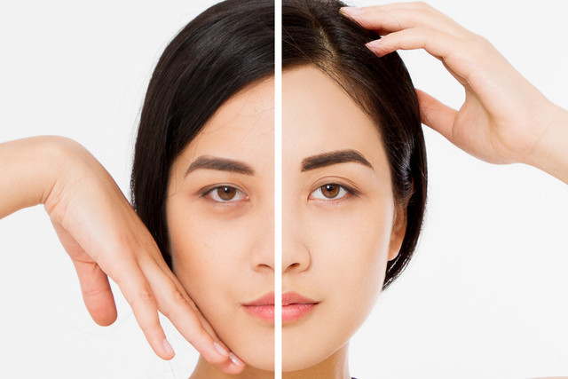 Ilustrasi brow lift. Foto: Zhur_Sa/shutterstock