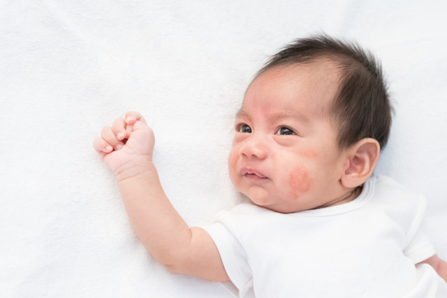 Ilustrasi herpes pada bayi. Foto: Shutterstock