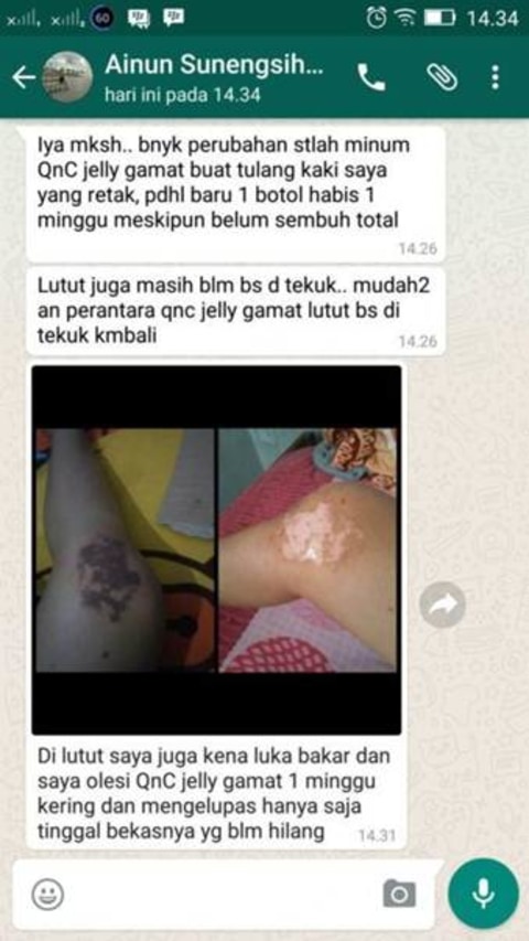 Cara Mengobati Luka Knalpot Agar Tidak Berbekas Kumparan Com