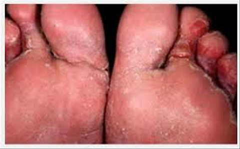 Cara Sembuhkan Eksim Dan Kudis Di Kaki Dengan Ramuan Alami Kumparan Com