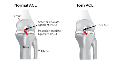 Tentang Cedera Ligamen Lutut Anterior Acl Dan Pesepak Bola - Acl mcl pcl lcl diagram
