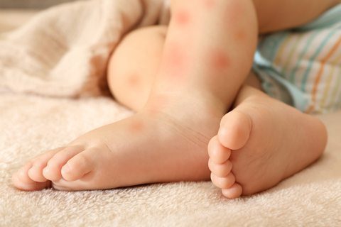 Lotion Calamine Apa Fungsi Dan Manfaatnya Untuk Bayi Kumparan Com