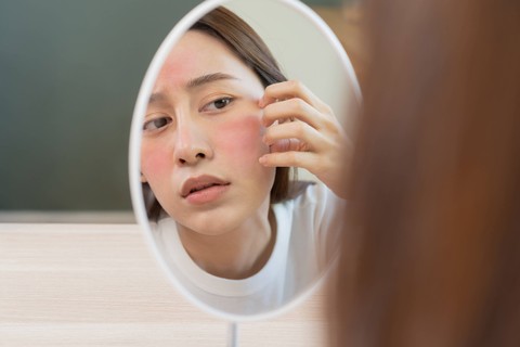 Ilustrasi kulit sun burn akibat tidak memakai sunscreen. Foto: Kmpzzz/Shutterstock