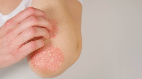 Ilustrasi perempuan mengalami psoriasis. Foto: Shutter Stock