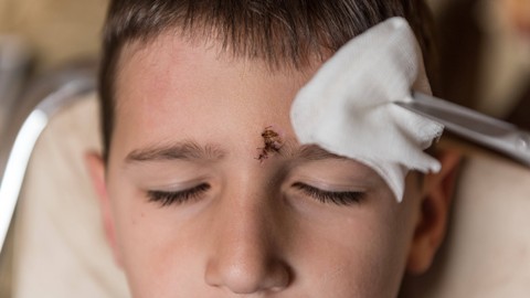 Ilustrasi bersihkan luka di kepala anak. Foto: Ivana P. Nikolic/Shutterstock