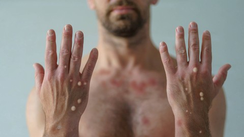 Ilustrasi cacar monyet atau Monkeypox. Foto: Halfpoint/Shutterstock