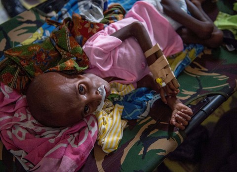 Seorang anak Papua yang menderita kekurangan gizi terbaring di ranjang rumah sakit untuk perawatan di Agats, ibu kota kabupaten Asmat di provinsi Papua paling timur Indonesia, pada 26 Januari 2018. Foto: Bay Ismoyo/AFP