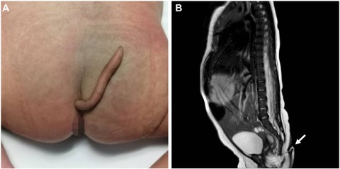 Ekor sepanjang 5,7 cm di bayi perempuan yang lahir di Nuevo Leon, Meksiko. Foto: Journal of Paediatric Surgery Case Reports