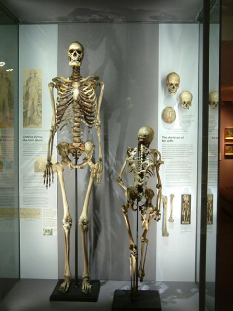 Kerangka manusia tertinggi di Irlandia, Charles Byrne. Foto: Doyal and Munizer/BMJ