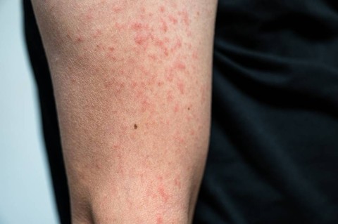 Ilustrasi campak pada orang dewasa. Foto: Shutter Stock