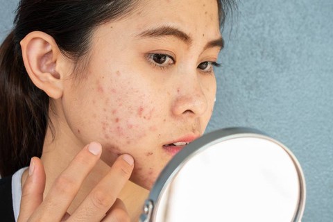 Stres menyebabkan masalah kulit. Foto: Shutterstock 
