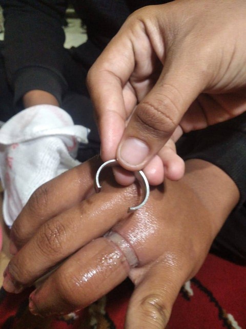 Jari warga yang bengkak akibat terlalu lama memakai cincin. Foto: Dok Hi!Pontianak