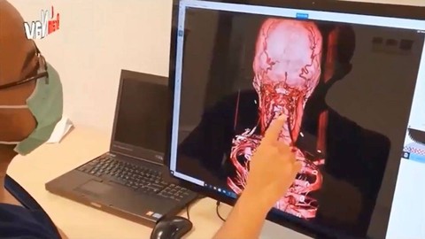 Profesor ITS Buat Sistem Stereotaktik Berbasis AI untuk Dukung Bedah Saraf Otak