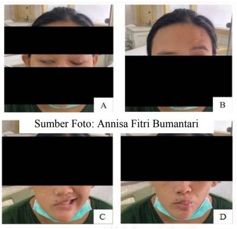 Contoh kelemahan otot wajah sisi kanan pada Bell's Palsy. Sumber: Annisa Fitri Bumantari