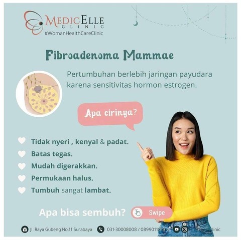 Angkat Benjolan/Tumor Jinak Payudara Tanpa Operasi? Apa Bisa? (1)