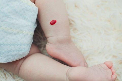 Tanda lahir hemangioma pada bayi. Foto: komokvm/Shutterstock