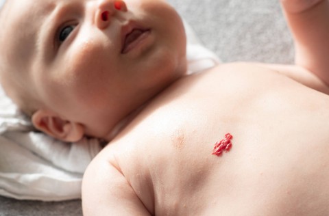 Tanda lahir hemangioma pada bayi. Foto: szmuli/Shutterstock