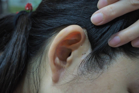 Ilustrasi sinus preauricular. Foto: yarak/Shutterstock