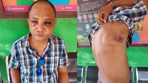Kondisi salah satu korban penganiayaan Anggota Satgas Gakkumla Lantamal VIII Manado. (foto: facebook Susanti Harimisa Bulahari)