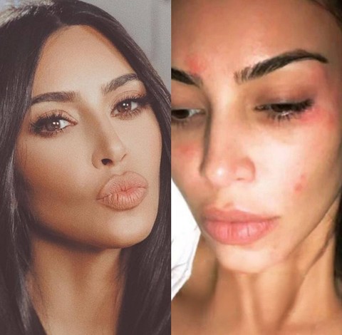 Perjuangan Kim Kardashian Melawan Jerawat. Foto: Instagram/@kimkardashian