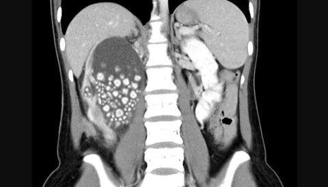 Penampakan batu ginjal di tubuh seorang wanita di Tainan, Taiwan.  Foto: Chi Mei Hospital