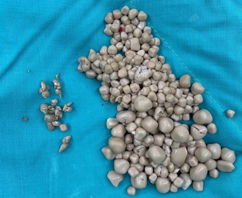 Lebih dari 300 batu ginjal diangkat dari tubuh wanita di Tainan, Taiwan.  Foto: Chi Mei Hospital