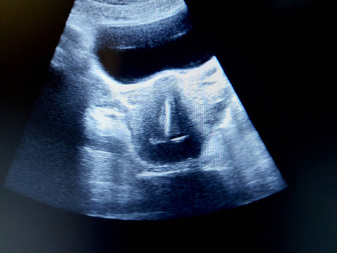 Kebobolan Hamil, Ternyata IUD Ibu Ini Patah dan Hilang, Kok Bisa Ya? Foto: Allo4e4ka/Shutterstock