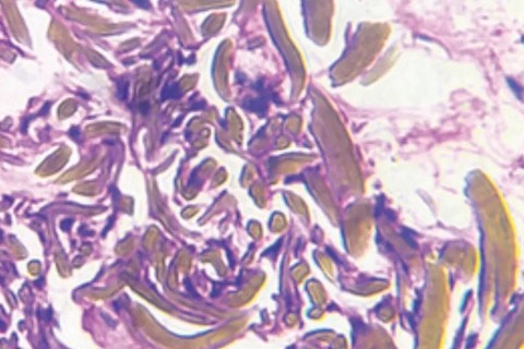 Sampel biopsi kulit dari pipi kiri wanita menunjukkan endapan ekstraseluler berwarna kuning kecokelatan berbentuk pisang. Ini adalah ciri khas okronosis eksogen. Foto: The New England Journal of Medicine