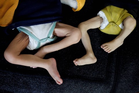 Anak-anak Palestina yang menderita kekurangan gizi menerima perawatan di pusat kesehatan, di tengah kelaparan yang meluas, ketika konflik antara Israel dan Hamas berlanjut, di Rafah, di selatan Jalur Gaza, Senin (4/3/2024). Foto: Mohammed Salem/REUTERS