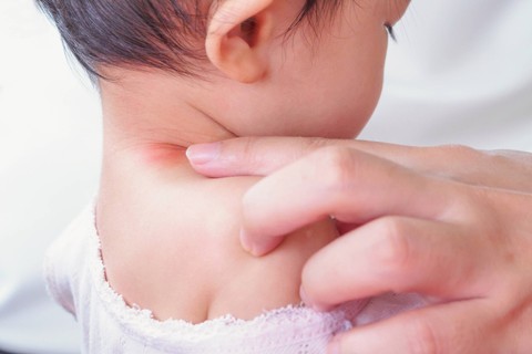Ruam leher pada bayi. Foto: Shutterstock