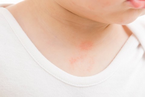 Ruam leher pada bayi. Foto: Shutterstock