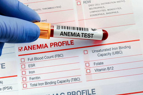 Ilustrasi Anemia. Foto: angellodeco/Shutterstock