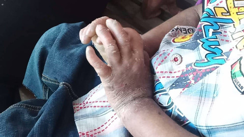 Kulit Alfi Azka, terdampak Epidermolisis Bulosa. Foto: Dok. Istimewa