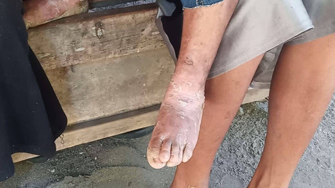 Alfi Azka (3), balita laki-laki asal Dusun/Desa Tulung, Kecamatan Saradan, Kabupaten Madiun mengidap penyakit kulit langka bernama Epidermolisis Bulosa. Foto: Dok. Istimewa