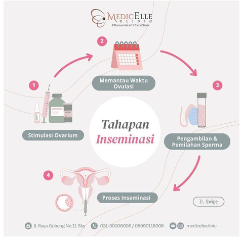 Mengenal Inseminasi Buatan, Apa Bedanya dengan Bayi Tabung? (2)