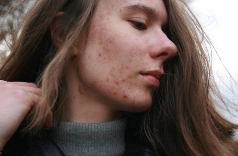 Ilustrasi Doa Menghilangkan Jerawat. Sumber Unsplash/Barbara Krysztofiak