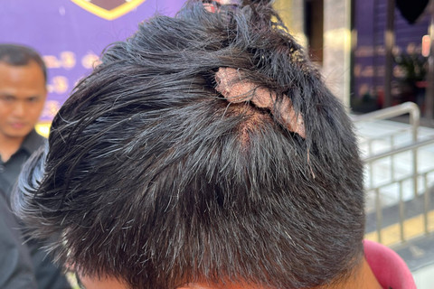 Farid sopir pengusaha Surabaya yang juga menjadi korban pengeroyokan sejumlah orang saat menunjukkan luka. Foto: Intan Alliva Khansa/kumparan