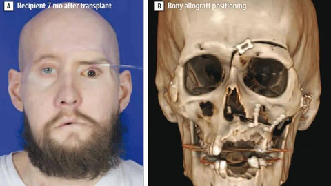Aaron James, 46 tahun, menjalani prosedur perintis ini setelah cedera listrik bertegangan tinggi yang menyebabkan kerusakan parah pada wajahnya. Foto: Dok. JAMA / Ceradini, D.J., et al