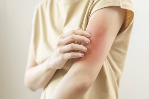 Ilustrasi eksim. Foto: Kmpzzz/Shutterstock