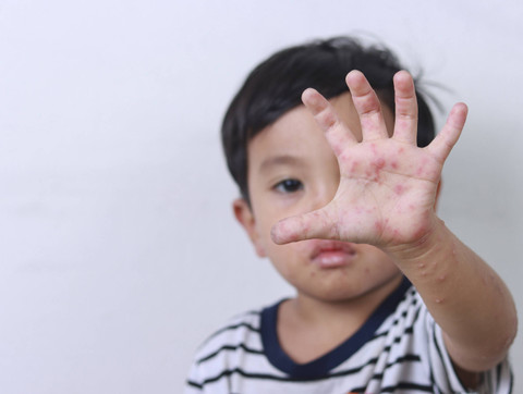 Ilustrasi Anak Kena Cacar Air. Foto: Shutterstock