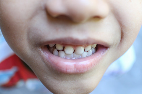 Gigi Berantakan Bisa Dicegah Sejak Dini, Moms! Ini Caranya. Foto: Bima Adhitya/Shutterstock