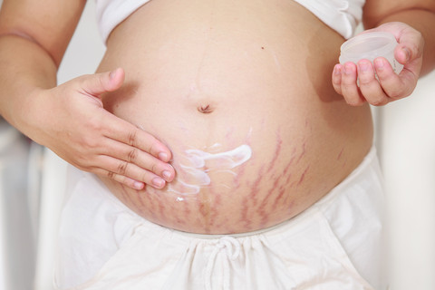 Stretch mark saat hamil. Foto: baipooh/Shutterstock